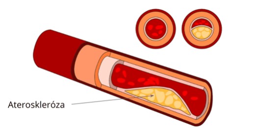 tepna postižená aterosklerozou