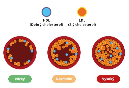 znázornění tří možných podob tepen podle různého obsahu cholesterolu