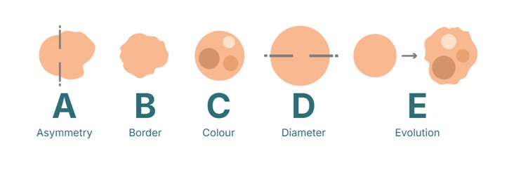 metoda abcde používaná pro kontrolu kožních znamének