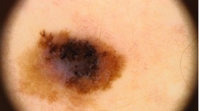 melanom pod mikroskopem