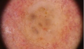 nádor nemelanomového typu pod mikroskopem