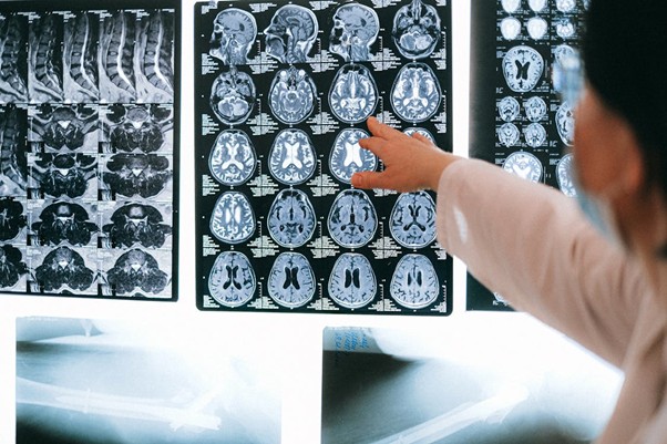 doktor ukazuje na prosvětlený rentgen mozku