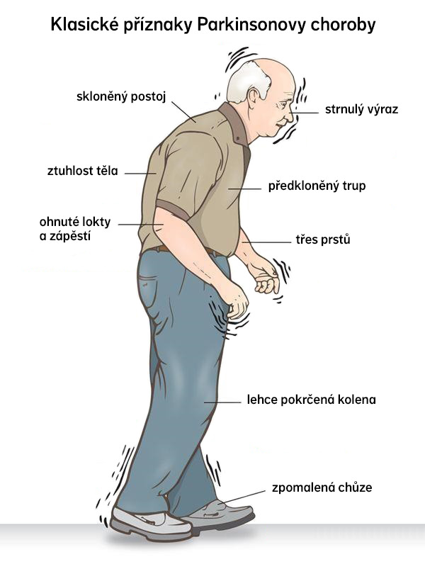 znázornění staršího muže s parkinsonem