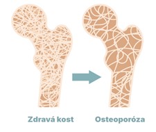 porovnání kosti zdravé s kostí s osteoporózou